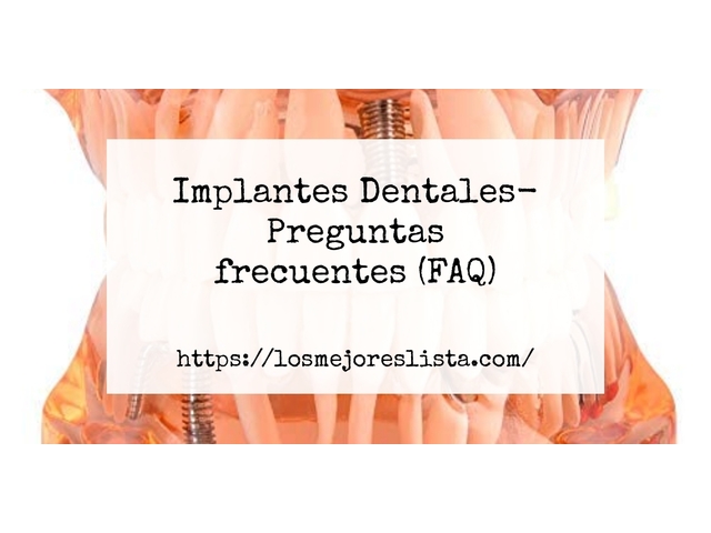 Implantes Dentales- Preguntas frecuentes (FAQ)